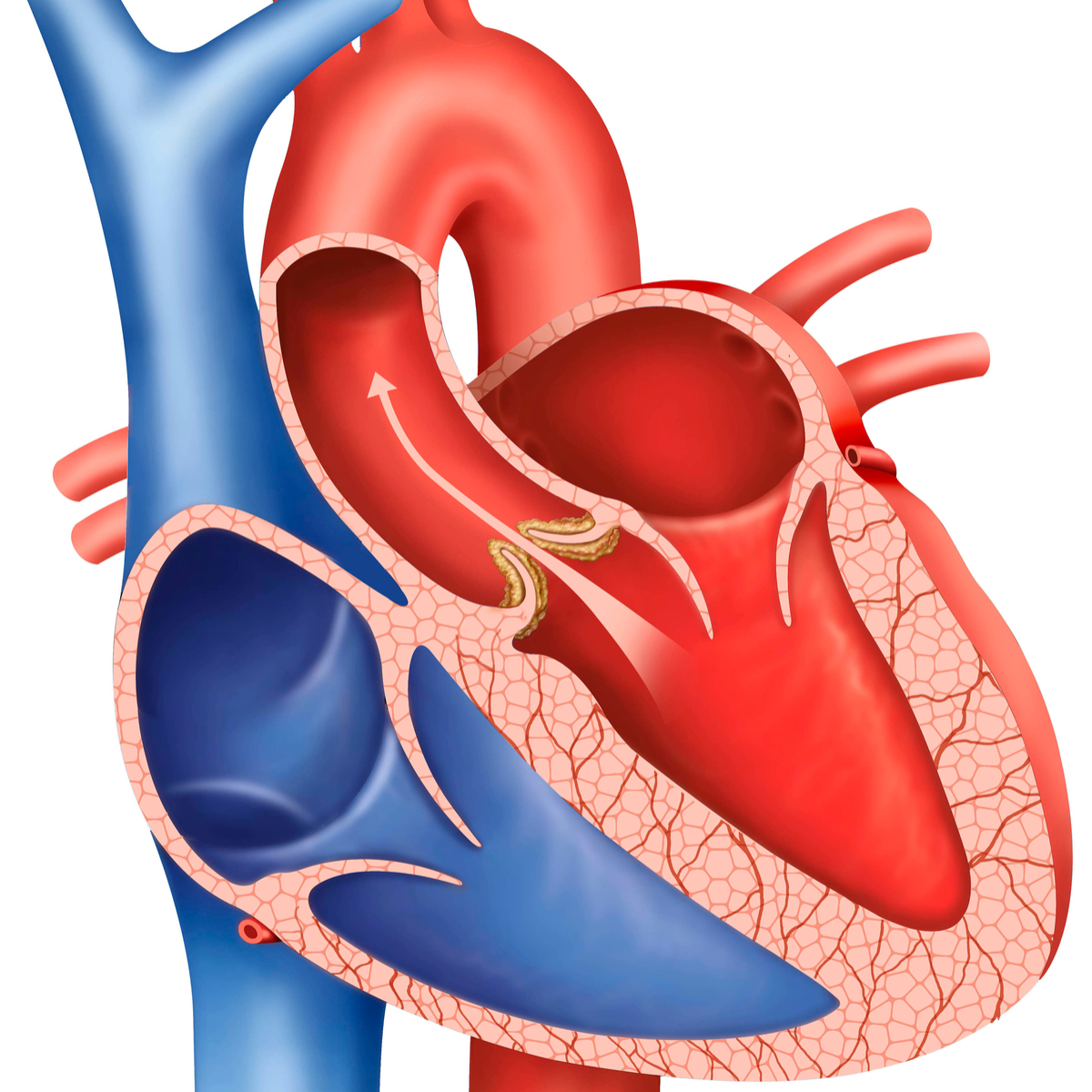 Featured image for “Cum se tratează stenoza aortică”