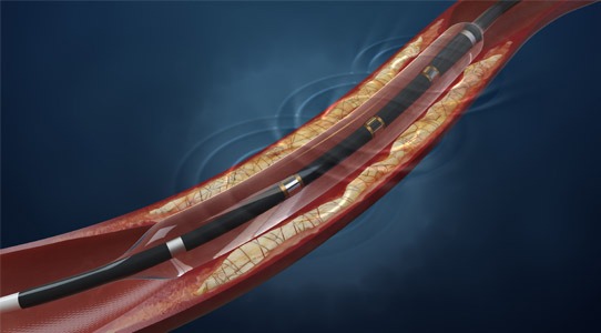 Featured image for “Terapia Shockwave pentru artere calcificate”