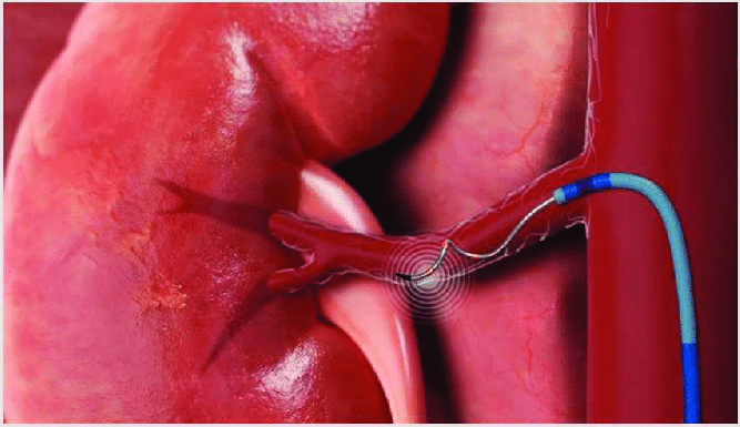 Featured image for “Denervarea renala | tratament hipertensiune arteriala”