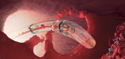 Tehnologia AngioJet in tromboza venoasa profunda si ischemia acuta de ...
