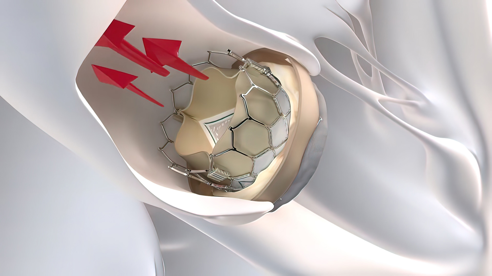 Featured image for “Tratamentul actual al stenozei aortice”