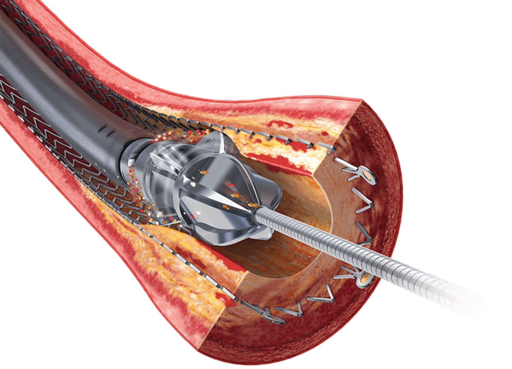 Featured image for “JetStream – aterectomie pentru artere sever calcificate”