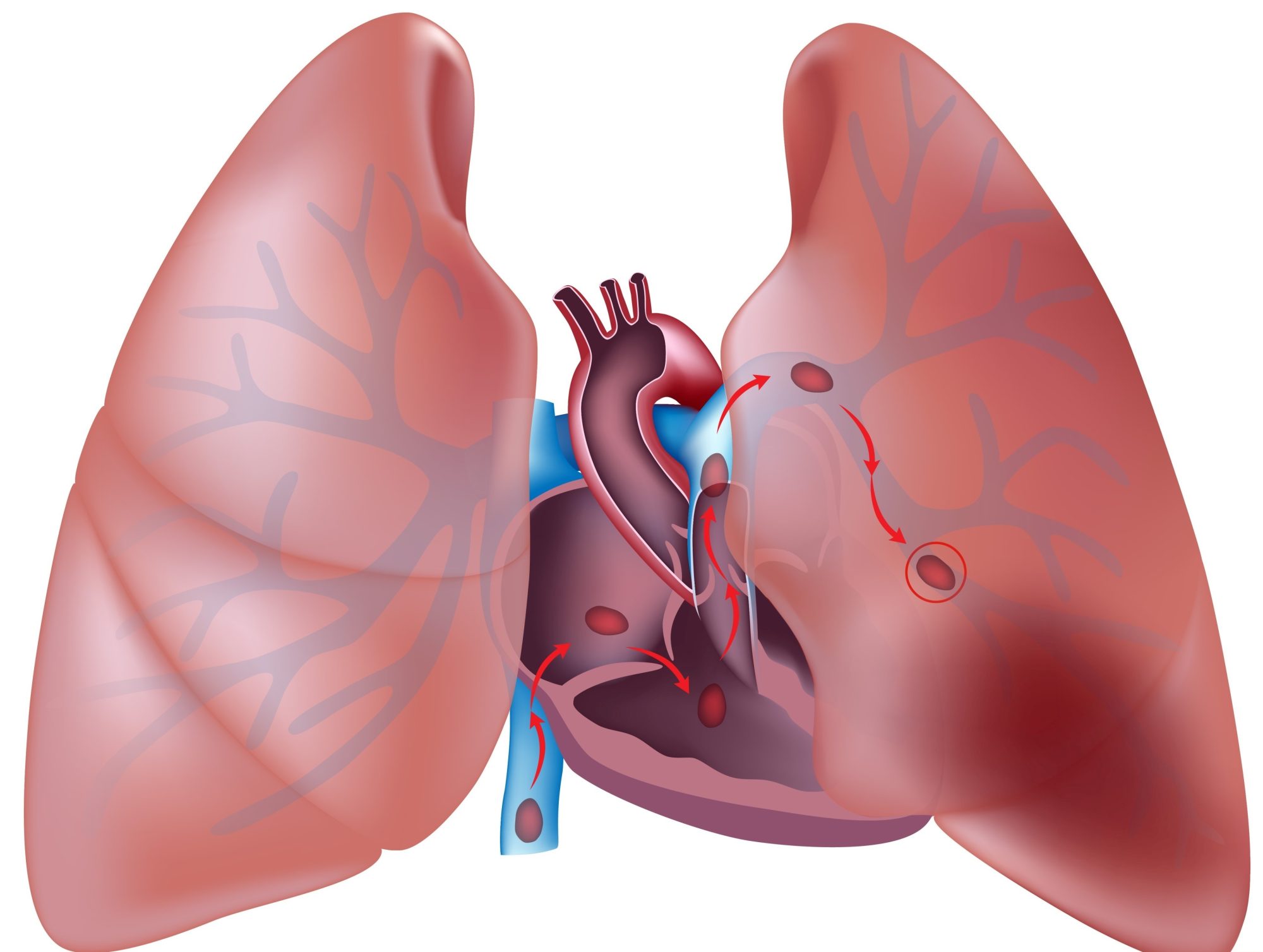 Featured image for “Trombembolismul pulmonar si tromboza venoasa profunda”