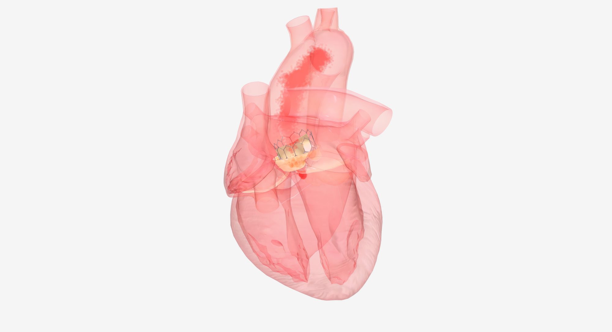 Featured image for “Optiuni de tratament in stenoza aortica”